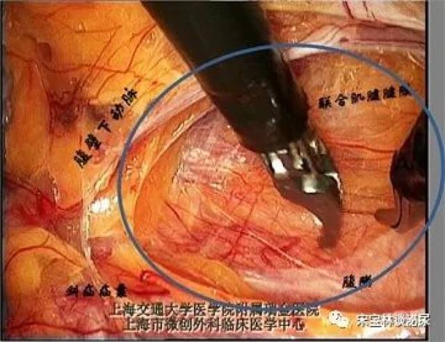 在腹壁下动脉的外侧轻轻的推开覆盖在联合肌腱上的腹横筋膜与