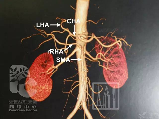 dsa 发现肝总动脉起自肠系膜上动脉