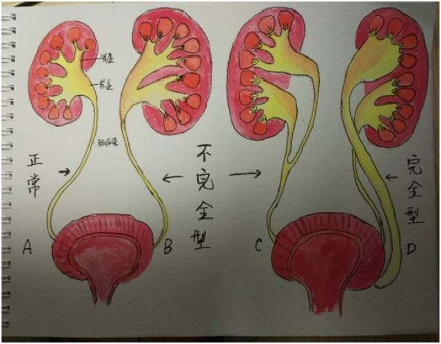 这棵树就会多个叉,形成一个y字型的输尿管或者一个输尿管连接两个肾盂