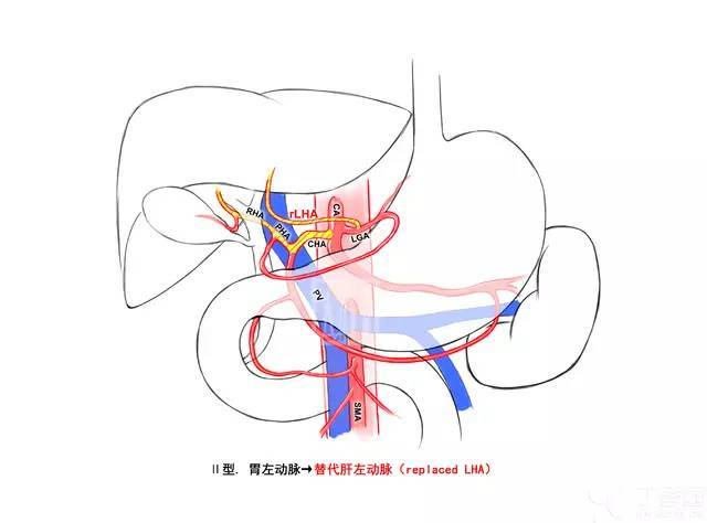 Ⅰ 型:正常型,即肝总动脉(cha)起源于腹腔动脉干(ca),发出肝固有动脉