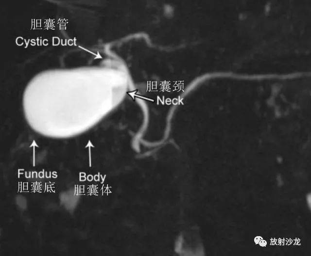 胆囊解剖示意图胆囊是位于肝脏后方的梨形囊状结构,位于肝脏iv和v段间