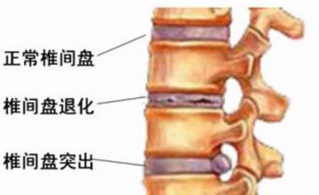 所以我们常说"l4~l5椎间盘突出"的意思就是第四节和第五节腰椎之间的