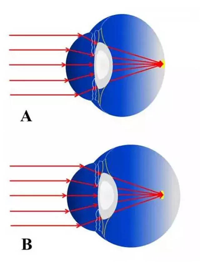 可见,近视发生时,眼睛的主要改变就是眼轴的伸长.