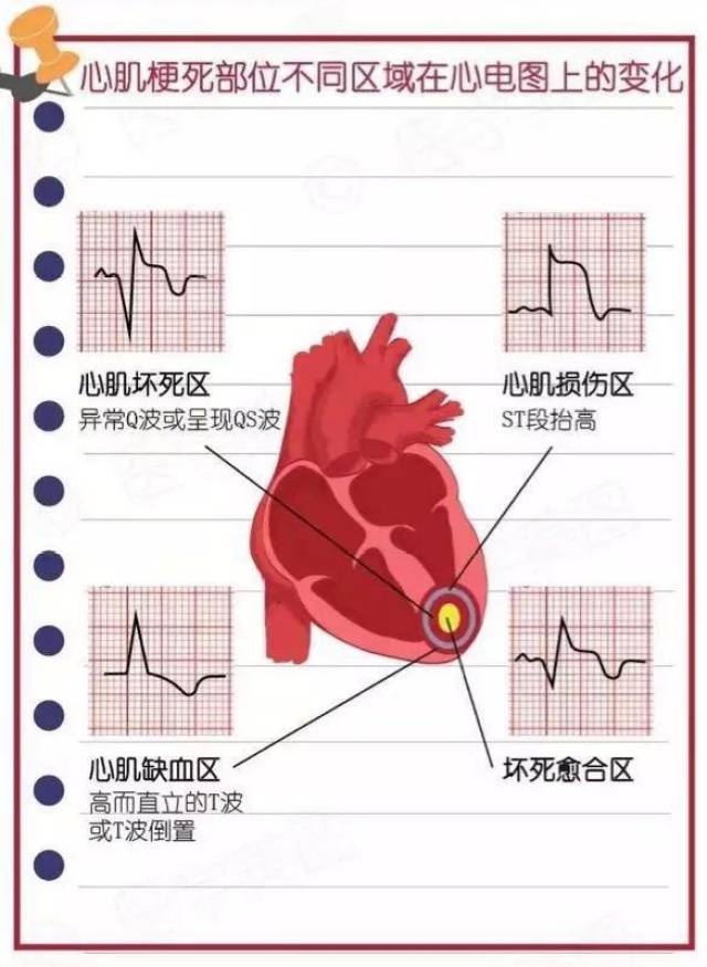 心电图之心肌梗死