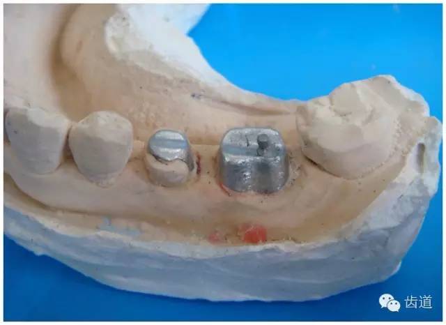 粘结力 l保留活髓及其整体性 l保留较多的牙体组织 l增加牙