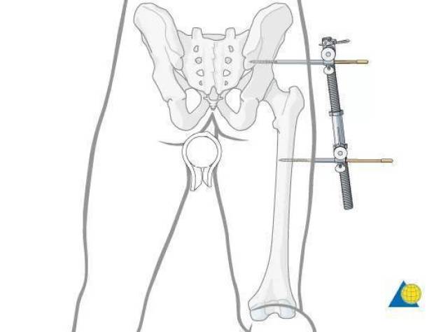 『大开眼界』扒一扒,骨科医生的那十八般兵器