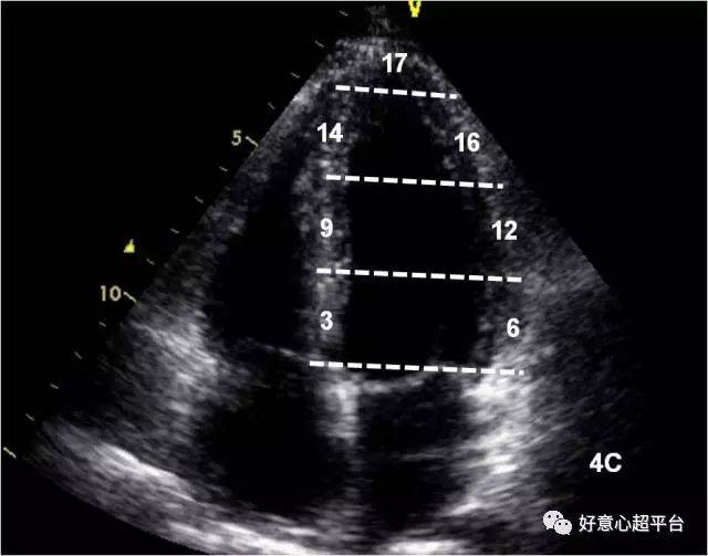 心尖二腔心(2c)切面,前壁(1,7,13),下壁(4,10,15),心尖段(17) 心尖四