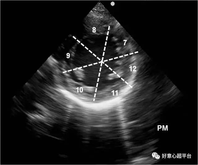 乳头肌(pm)水平左室短轴切面,中部7-12段