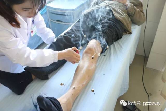 中医理疗医师在为患者做温针灸治疗