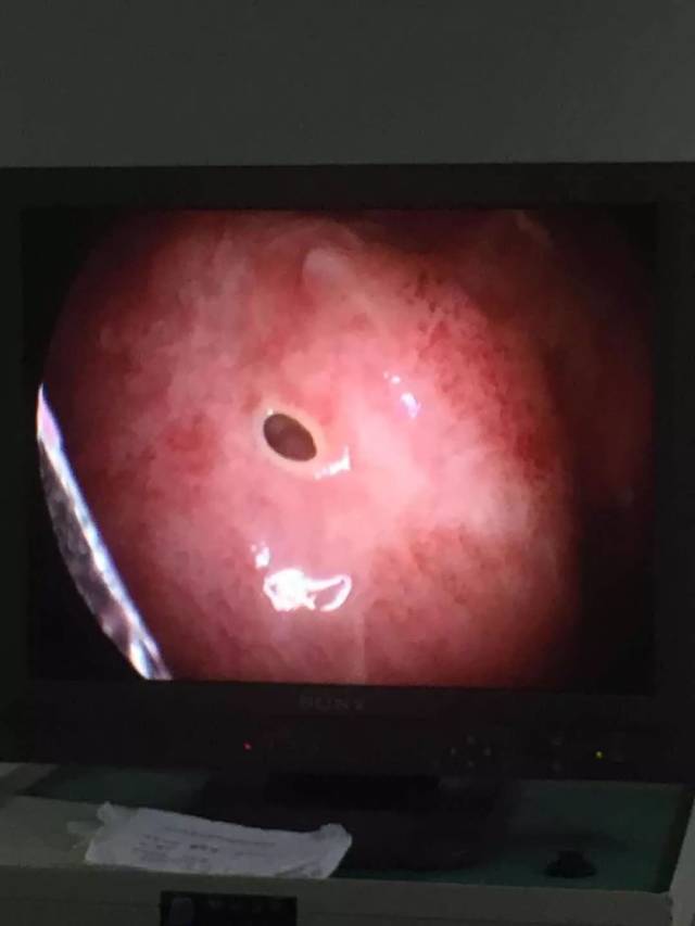 外科成功开展首例经腹腔镜胃肠穿孔修补术