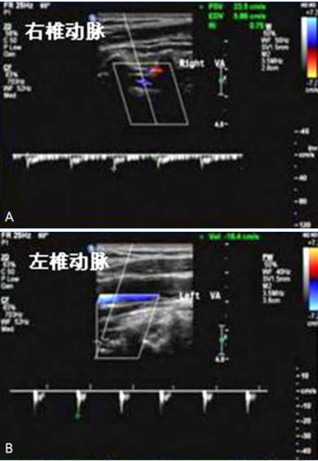 颈部血管超声检查结果:①双侧颈部动脉斑块形成(多发,等回声斑块);②