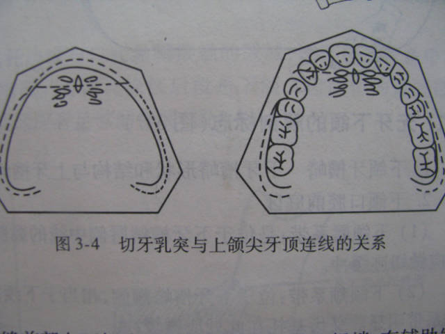 切牙乳突 是制作腊提和排牙时有用的参考标志,在天然牙列,中切牙唇面