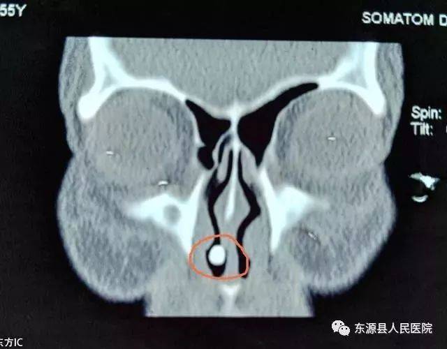 湖南女子鼻塞数十年,竟然是鼻子里长了颗恐怖的牙