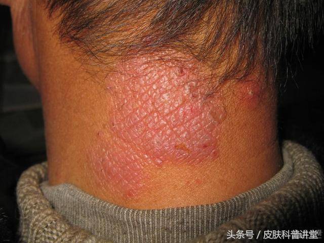 哪些皮肤病最怕生气?为了自己皮肤少生气吧