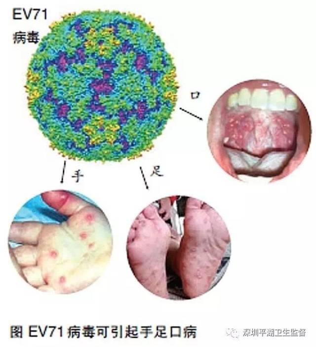 【上木古·卫生保健】手足口病高发季,家庭,学校,托幼