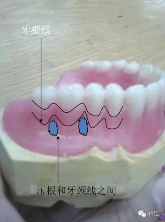 图说全口义齿蜡型及龈沟修整要点