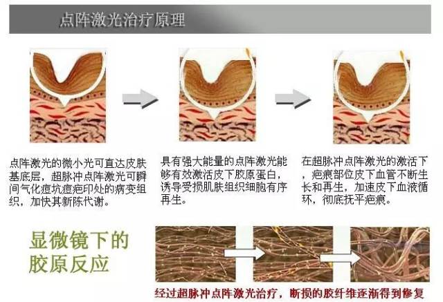 co点阵激光,给我六天还您六年!