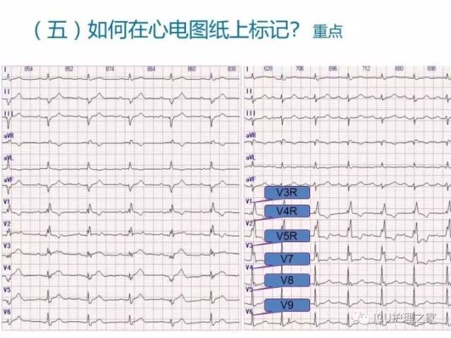 心电图机的操作,12导联,18导联链接详解!