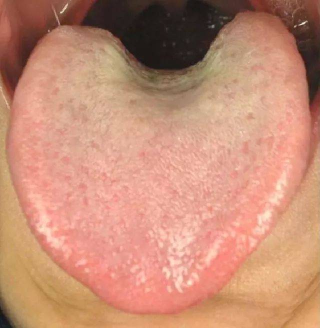 因为长期饮用白酒或者是食用过烫的食物 舌两边发红 提示 肝胆热盛,肝