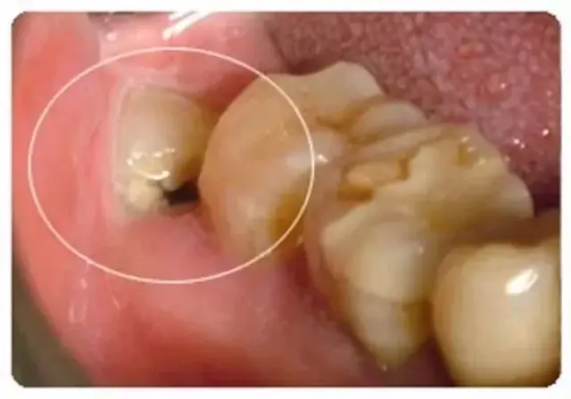 能保留的智齿需要符合这几个特征:上下智齿正确的,完整的萌出,能建立