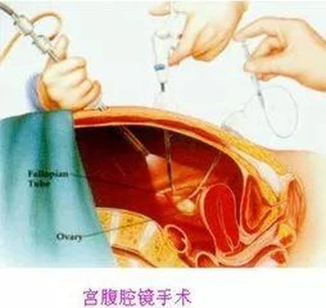 输卵管成型术,输卵管结扎术之后可能会留下疤痕组织,导致输卵管通而不