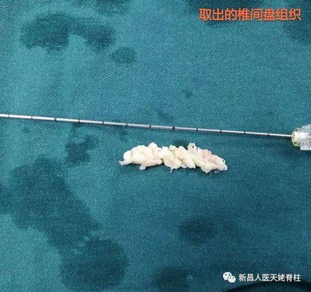 腰腿疼痛莫要愁椎间孔镜解烦忧