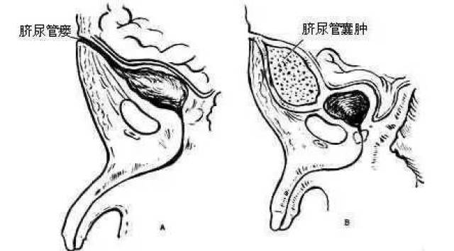 浙江:12岁男孩的肚脐眼,竟然冒水!冒的还不是一般的水