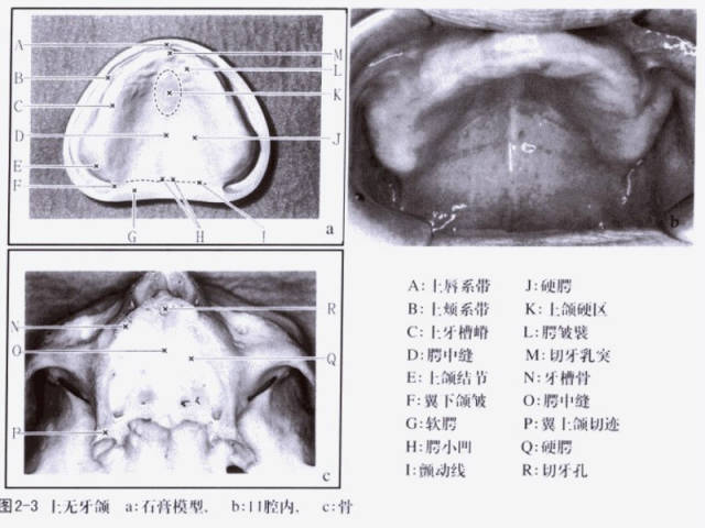 无牙颌活动义齿取模技巧