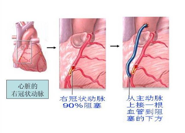 心脏搭桥手术后,要想"心痛"不反复?护理就得做好这8点