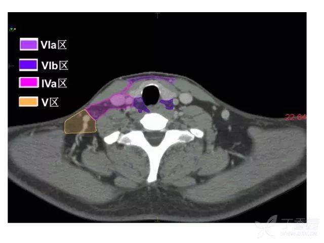 史上最精细:头颈部淋巴结分区 ct 图谱