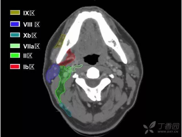 史上最精细:头颈部淋巴结分区 ct 图谱