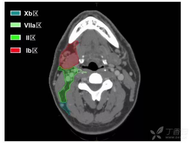 史上最精细:头颈部淋巴结分区 ct 图谱