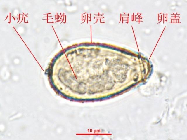 油镜下肝吸虫卵和灵芝孢子(右)