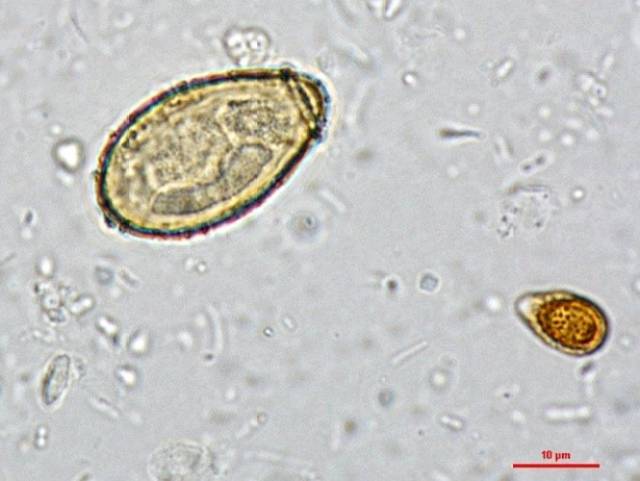 高倍镜下肝吸虫卵