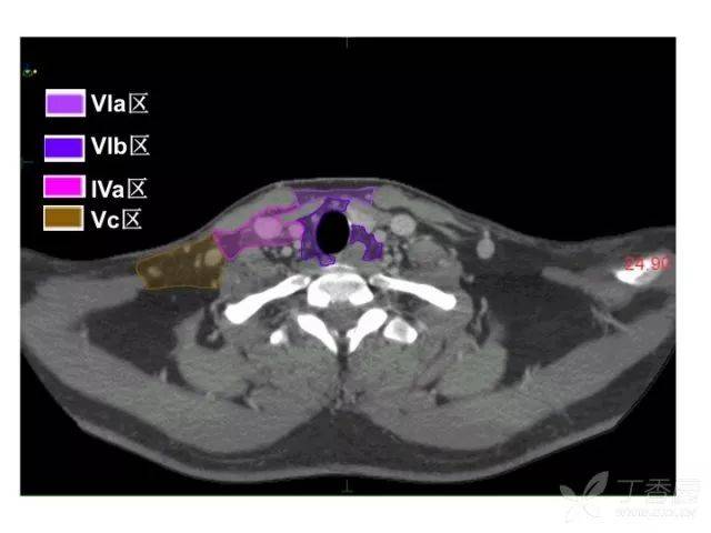 史上最精细:头颈部淋巴结分区 ct 图谱