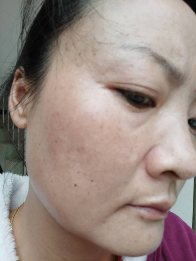 【康复案例】面部色斑理疗康复案例——徐进平分享