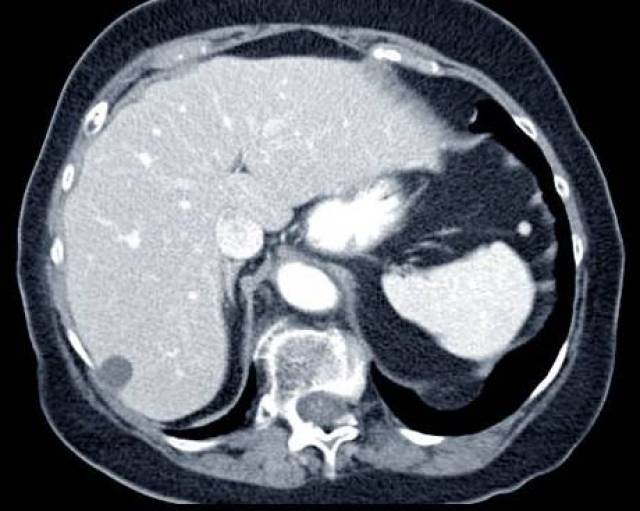 答案 b. 肝部mri