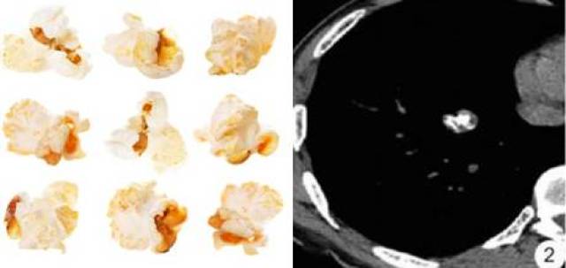 【零食篇】  爆米花样钙化:肺错构瘤出现钙化时,ct表现呈爆米花样