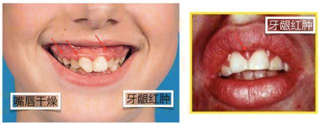 1,牙龈红肿 这个原理同口腔溃疡和扁桃体,腺样体肿大,都是因为空气未