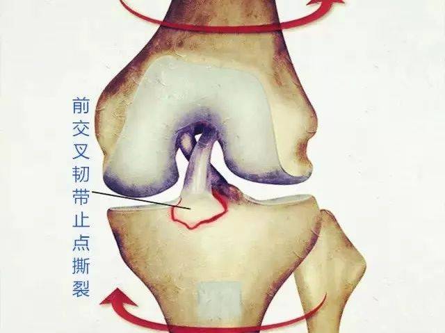 前交叉韧带撕裂——运动时的那一阵剧烈疼痛