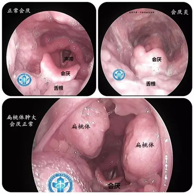 下面请北京市第一中西医结合医院耳鼻喉科专家为大家详细讲解一下会厌