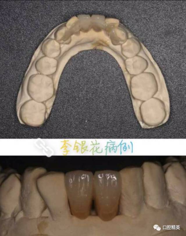 牙周病牙齿缺失修复这种修复可能更合适