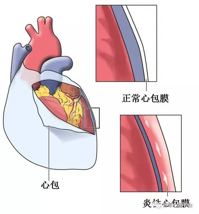 图13:急性心包炎患者,右室前壁近心尖部心包脏层和壁层均增厚,少量心