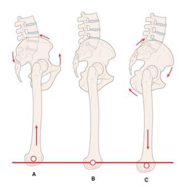 "长短腿"不是腿的问题,不是骨盆的问题,究竟是谁的问题?