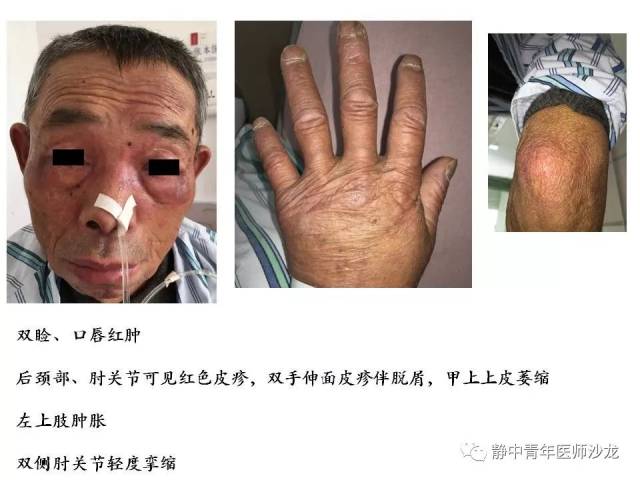 通过经典病例让我们学习了皮肌炎特有的皮肤损害,便于我们今后在临床