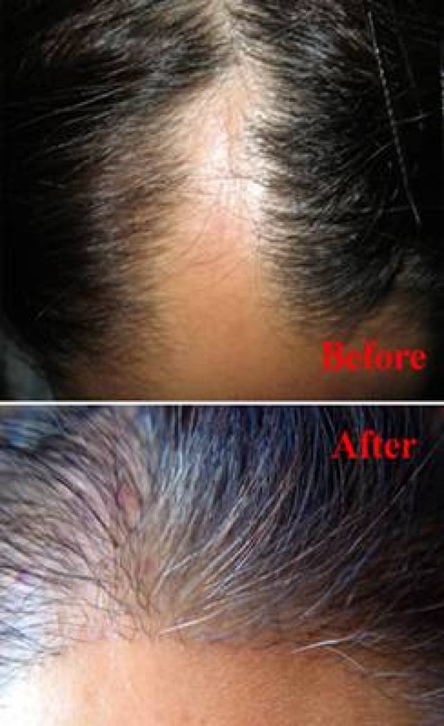 头皮局限性硬皮病患者毛发移植手术后毛发再生,萎缩变薄的头皮恢复了