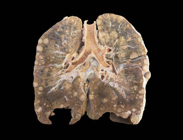 早期肺癌可以治愈?正确治疗,存活率可达88%