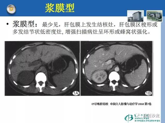 【每日一例 480例】右胁肋部疼痛一周,肝内占位3天