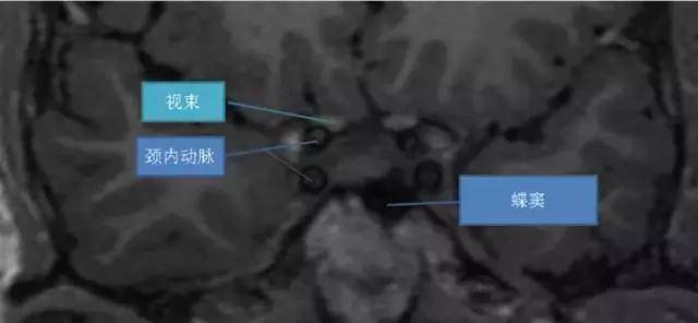 海绵窦区核磁共振影像解剖