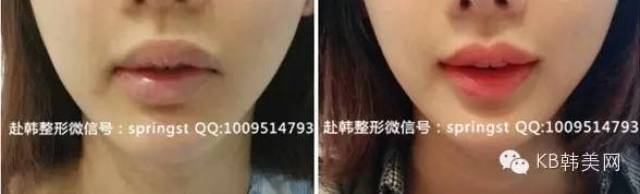 解析什么是微笑唇整形!